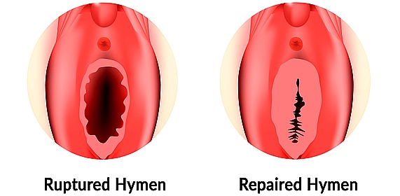 vaginal restoration in nashik